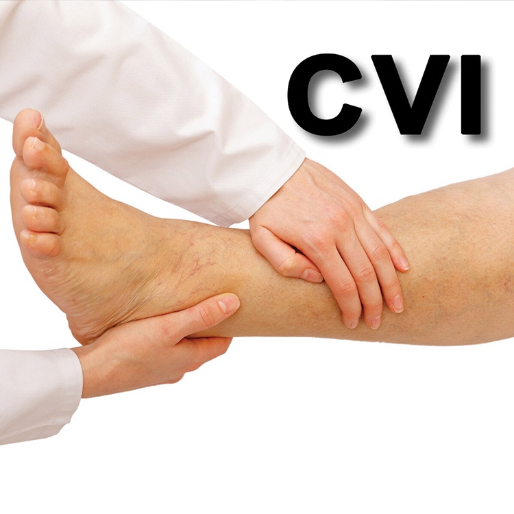 Can You Win Disability Benefits for Chronic Venous Insufficiency?